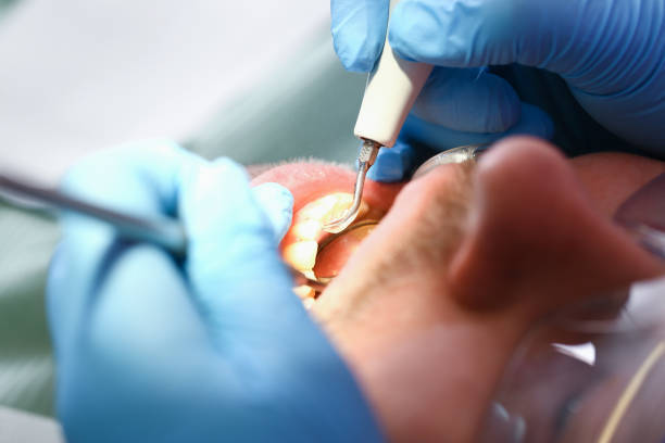 Best Emergency Dental Care for Broken or Chipped Teeth in Tawas City, MI